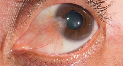 corneal disorder treatments toronto